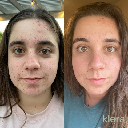 Daily Acne Support for Teens
